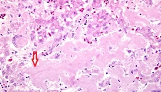 養雞技術 | 雞肝臟腫大出血再認識：淀粉樣變